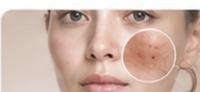 Nám và sắc tố